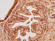 IHC image of CSB-PA750884LA01HU diluted at 1:100 and staining in paraffin-embedded human endometrial cancer performed on a Leica BondTM system. After dewaxing and hydration, antigen retrieval was mediated by high pressure in a citrate buffer (pH 6...