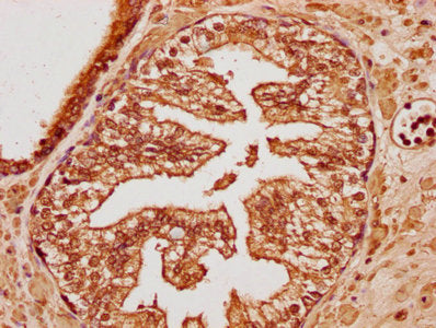 IHC image of CSB-PA750884LA01HU diluted at 1:100 and staining in paraffin-embedded human endometrial cancer performed on a Leica BondTM system. After dewaxing and hydration, antigen retrieval was mediated by high pressure in a citrate buffer (pH 6...