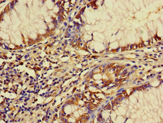 Immunohistochemistry of paraffin-embedded human colon cancer using CSB-PA751062LA01HU at dilution of 1:100