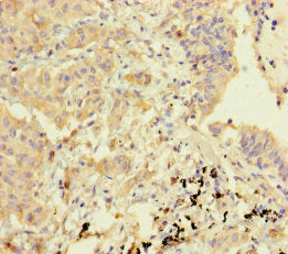 Immunohistochemistry of paraffin-embedded human lung cancer using CSB-PA751154LA01HU at dilution of 1:100