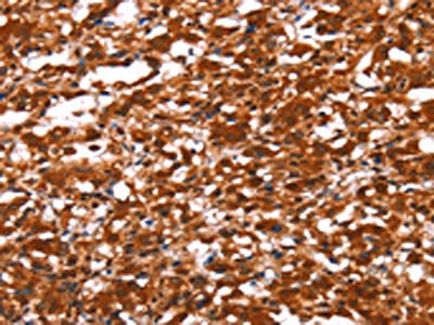 The image on the left is immunohistochemistry of paraffin-embedded Human thyroid cancer tissue using CSB-PA752513(FUT1 Antibody) at dilution 1/30, on the right is treated with synthetic peptide. (Original magnification: ×200)