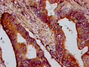 IHC image of CSB-PA752530LA01HU diluted at 1:400 and staining in paraffin-embedded human colon cancer performed on a Leica BondTM system. After dewaxing and hydration, antigen retrieval was mediated by high pressure in a citrate buffer (pH 6.0). S...