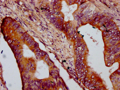 IHC image of CSB-PA752530LA01HU diluted at 1:400 and staining in paraffin-embedded human colon cancer performed on a Leica BondTM system. After dewaxing and hydration, antigen retrieval was mediated by high pressure in a citrate buffer (pH 6.0). S...