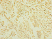 Immunohistochemistry of paraffin-embedded human pancreatic cancer using CSB-PA752534ESR1HU at dilution of 1:100