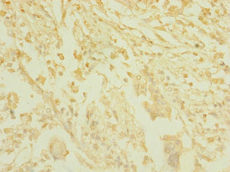 Immunohistochemistry of paraffin-embedded human pancreatic cancer using CSB-PA752534ESR1HU at dilution of 1:100