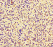 Immunohistochemistry of paraffin-embedded human glioma using CSB-PA754170LA01HU at dilution of 1:100