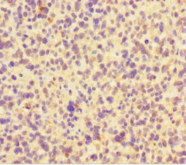 Immunohistochemistry of paraffin-embedded human glioma using CSB-PA754170LA01HU at dilution of 1:100