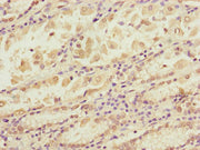 Immunohistochemistry of paraffin-embedded human gastric cancer using CSB-PA754307ESR1HU at dilution of 1:100