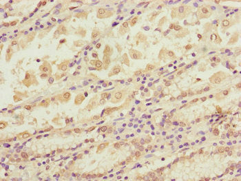 Immunohistochemistry of paraffin-embedded human gastric cancer using CSB-PA754307ESR1HU at dilution of 1:100