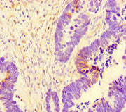 Immunohistochemistry of paraffin-embedded human ovarian cancer using CSB-PA754474LA01HU at dilution of 1:100