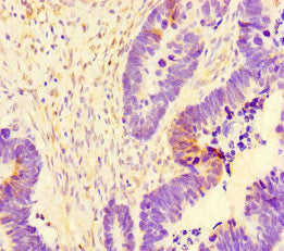 Immunohistochemistry of paraffin-embedded human ovarian cancer using CSB-PA754474LA01HU at dilution of 1:100