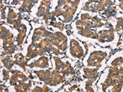 The image on the left is immunohistochemistry of paraffin-embedded Human breast cancer tissue using CSB-PA755352(ELP3 Antibody) at dilution 1/35, on the right is treated with synthetic peptide. (Original magnification: ×200)