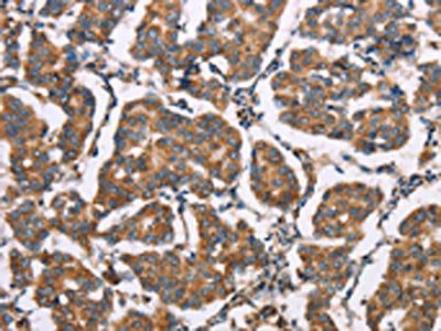 The image on the left is immunohistochemistry of paraffin-embedded Human breast cancer tissue using CSB-PA755352(ELP3 Antibody) at dilution 1/35, on the right is treated with synthetic peptide. (Original magnification: ×200)