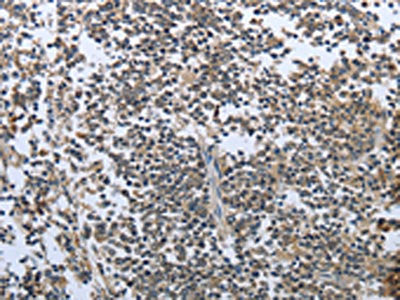 The image on the left is immunohistochemistry of paraffin-embedded Human tonsil tissue using CSB-PA755885(PRL Antibody) at dilution 1/30, on the right is treated with fusion protein. (Original magnification: ×200)