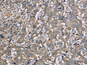 The image on the left is immunohistochemistry of paraffin-embedded Human liver cancer tissue using CSB-PA756613(DTNB Antibody) at dilution 1/50, on the right is treated with fusion protein. (Original magnification: ×200)