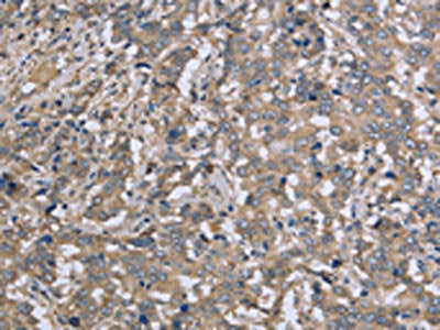 The image on the left is immunohistochemistry of paraffin-embedded Human liver cancer tissue using CSB-PA756613(DTNB Antibody) at dilution 1/50, on the right is treated with fusion protein. (Original magnification: ×200)