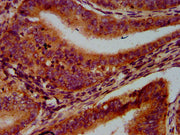 IHC image of CSB-PA757083LA01HU diluted at 1:600 and staining in paraffin-embedded human endometrial cancer performed on a Leica BondTM system. After dewaxing and hydration, antigen retrieval was mediated by high pressure in a citrate buffer (pH 6...