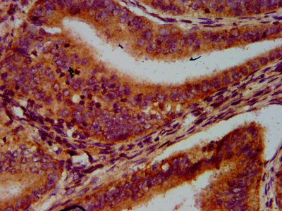 IHC image of CSB-PA757083LA01HU diluted at 1:600 and staining in paraffin-embedded human endometrial cancer performed on a Leica BondTM system. After dewaxing and hydration, antigen retrieval was mediated by high pressure in a citrate buffer (pH 6...