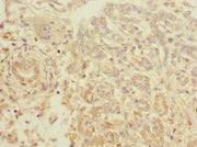 Immunohistochemistry of paraffin-embedded human pancreatic cancer using CSB-PA757502LA01HU at dilution of 1:100
