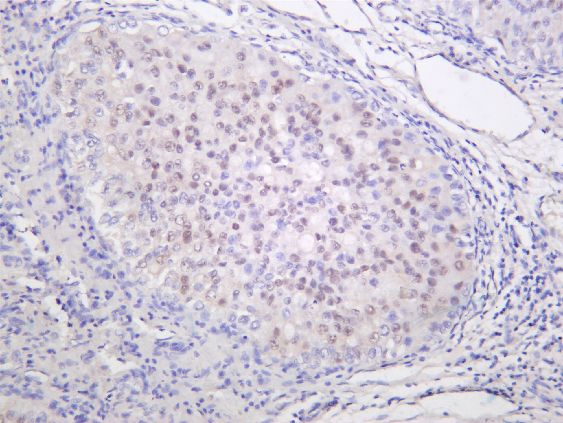 Human hepatocellular carcinoma was stained with anti-Smad2 (phospho Ser250) (PT0058R) rabbit antibody