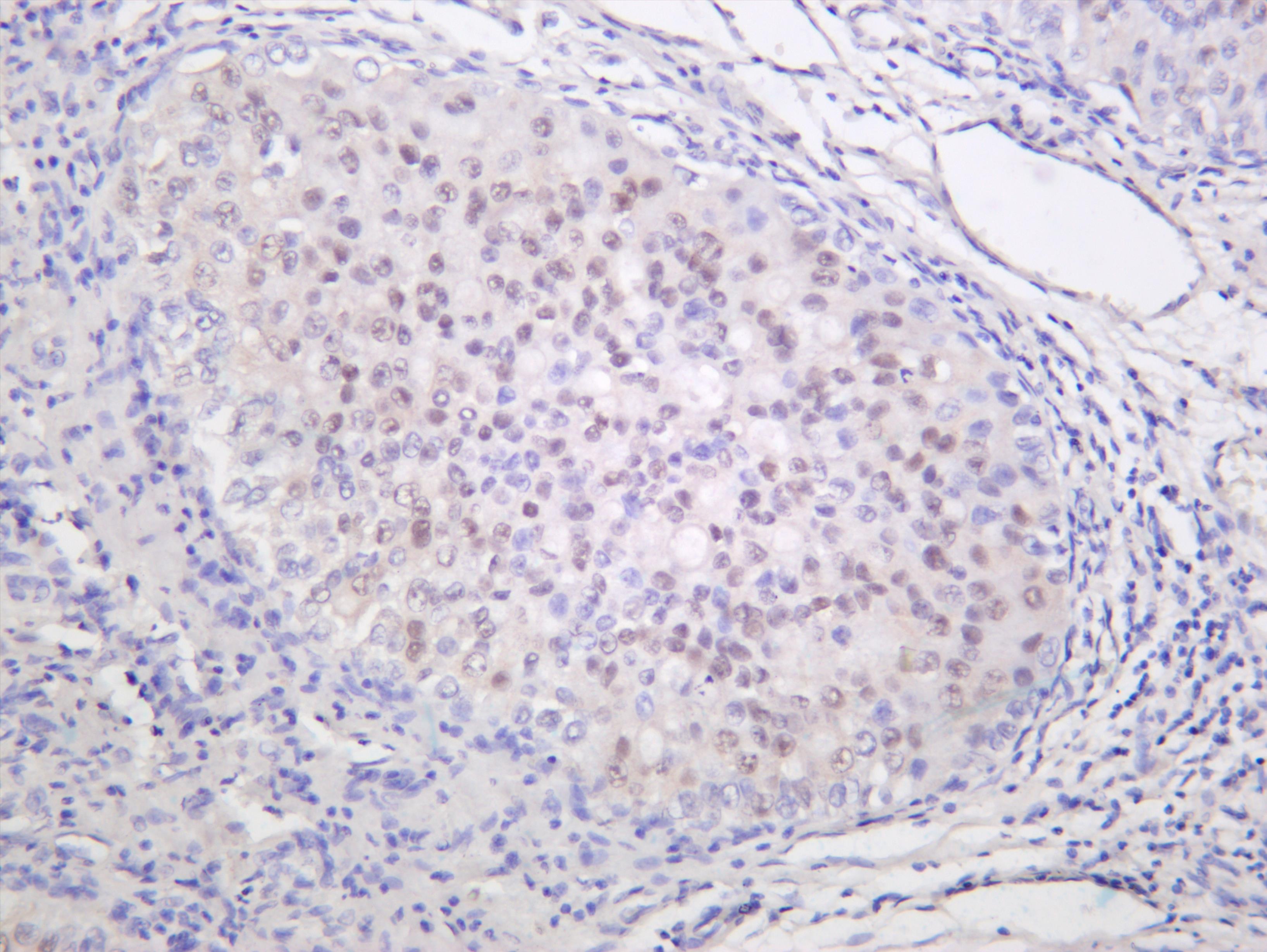 Human hepatocellular carcinoma was stained with anti-Smad2 (phospho Ser250) (PT0058R) rabbit antibody