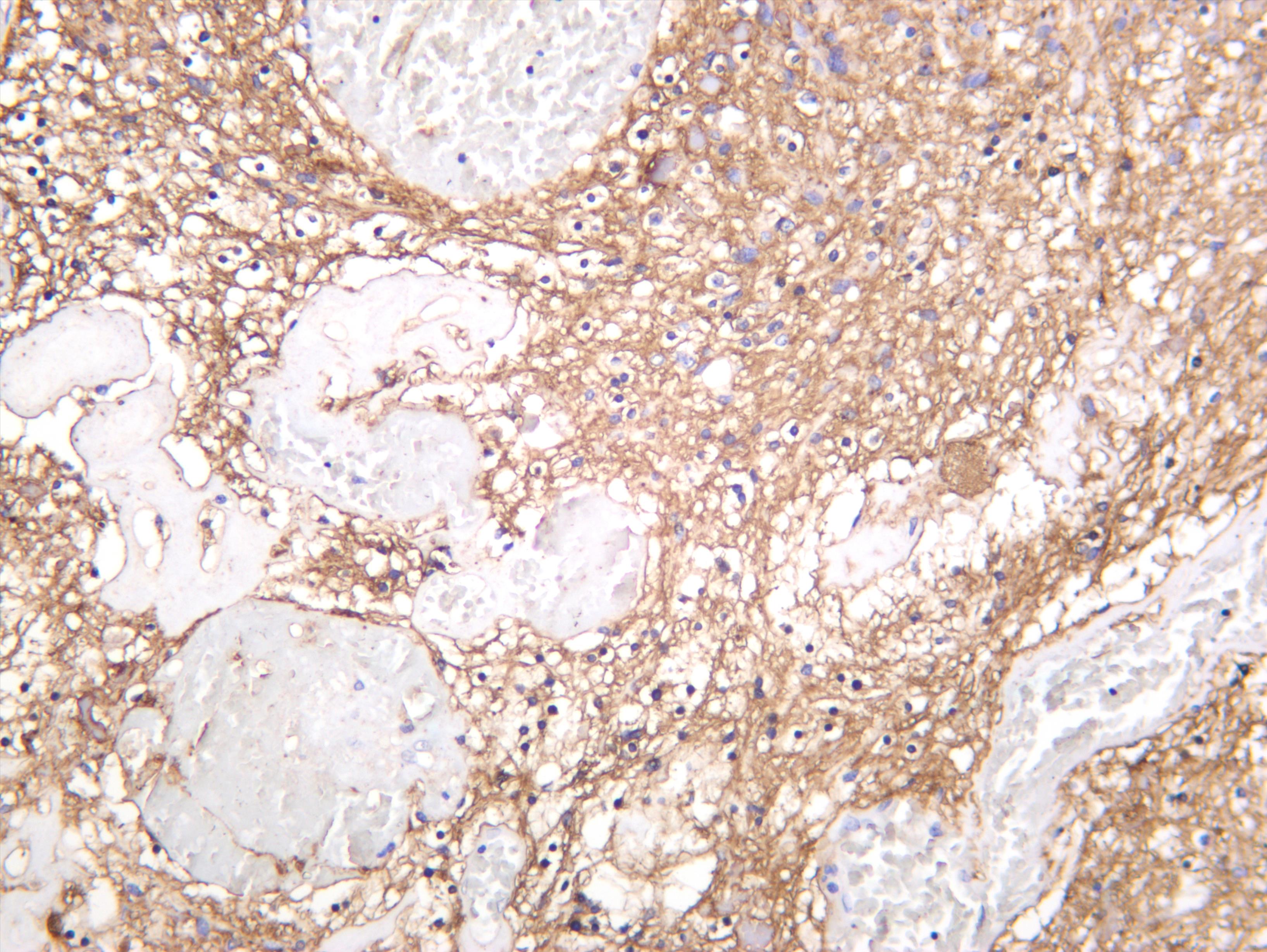 Human glioma was stained with anti-GAP43 (PT0304R) rabbit antibody