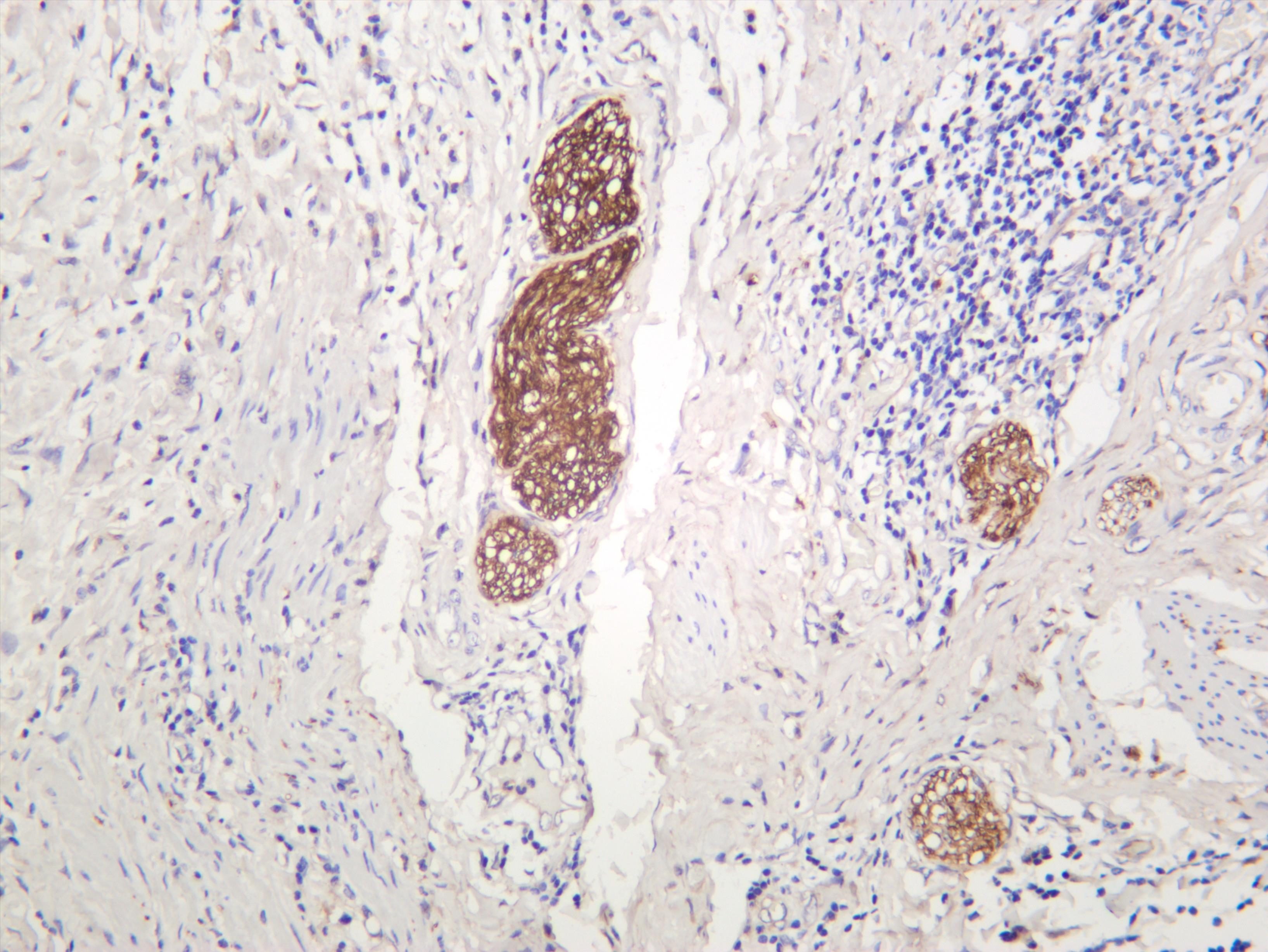 Human cervical carcinoma was stained with anti-ATG7 (PT0335R) rabbit antibody