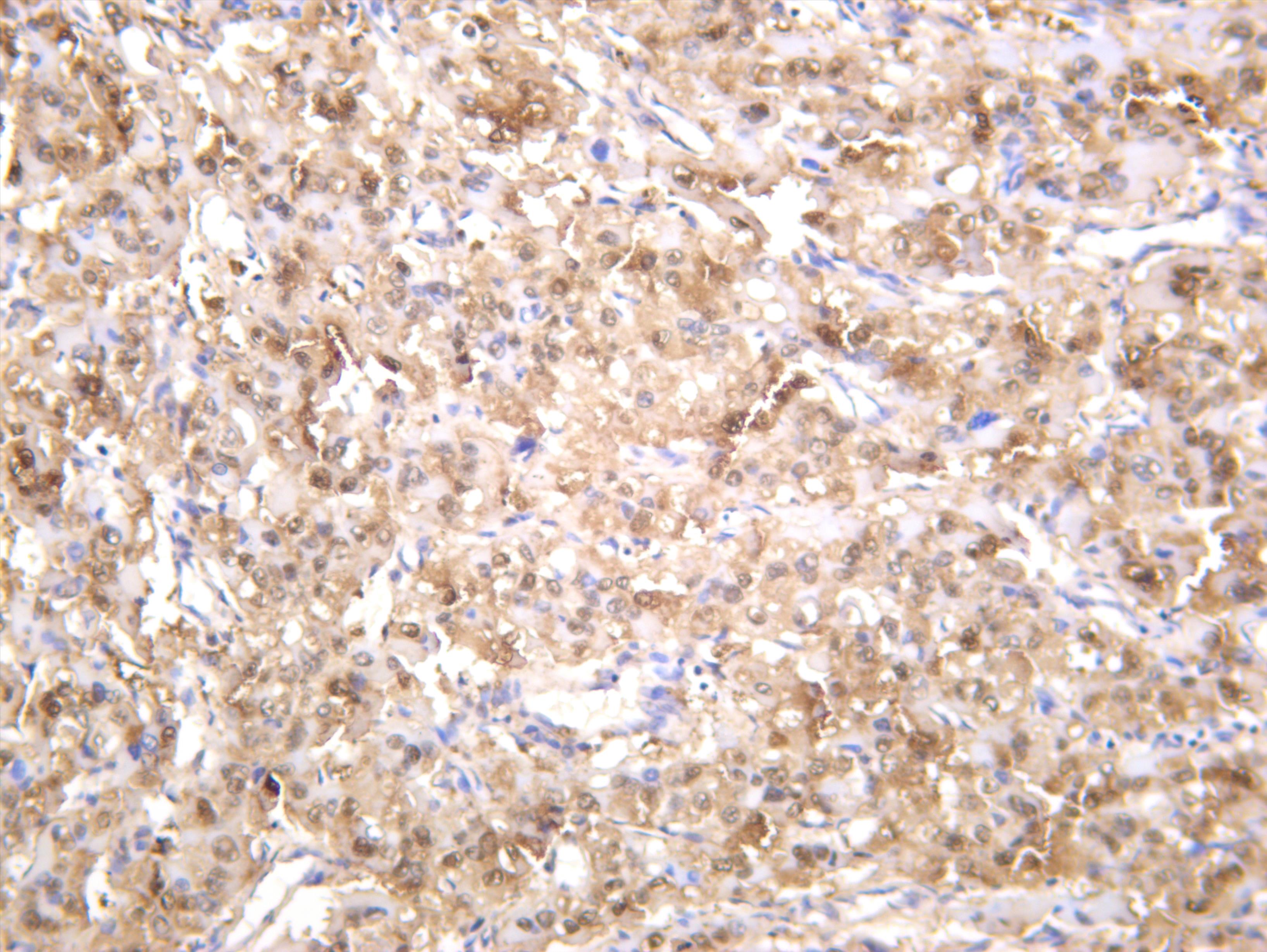 Human hepatocellular carcinoma was stained with anti-Arginase-1 (PT0364R) rabbit antibody