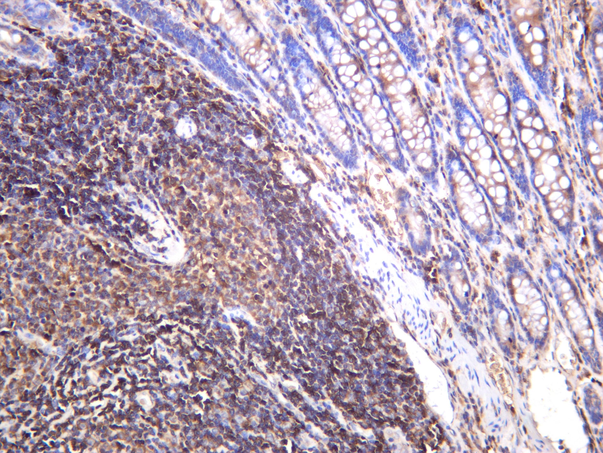 Human colon carcinoma was stained with anti-p90RSK (phospho Ser380) rabbit antibody