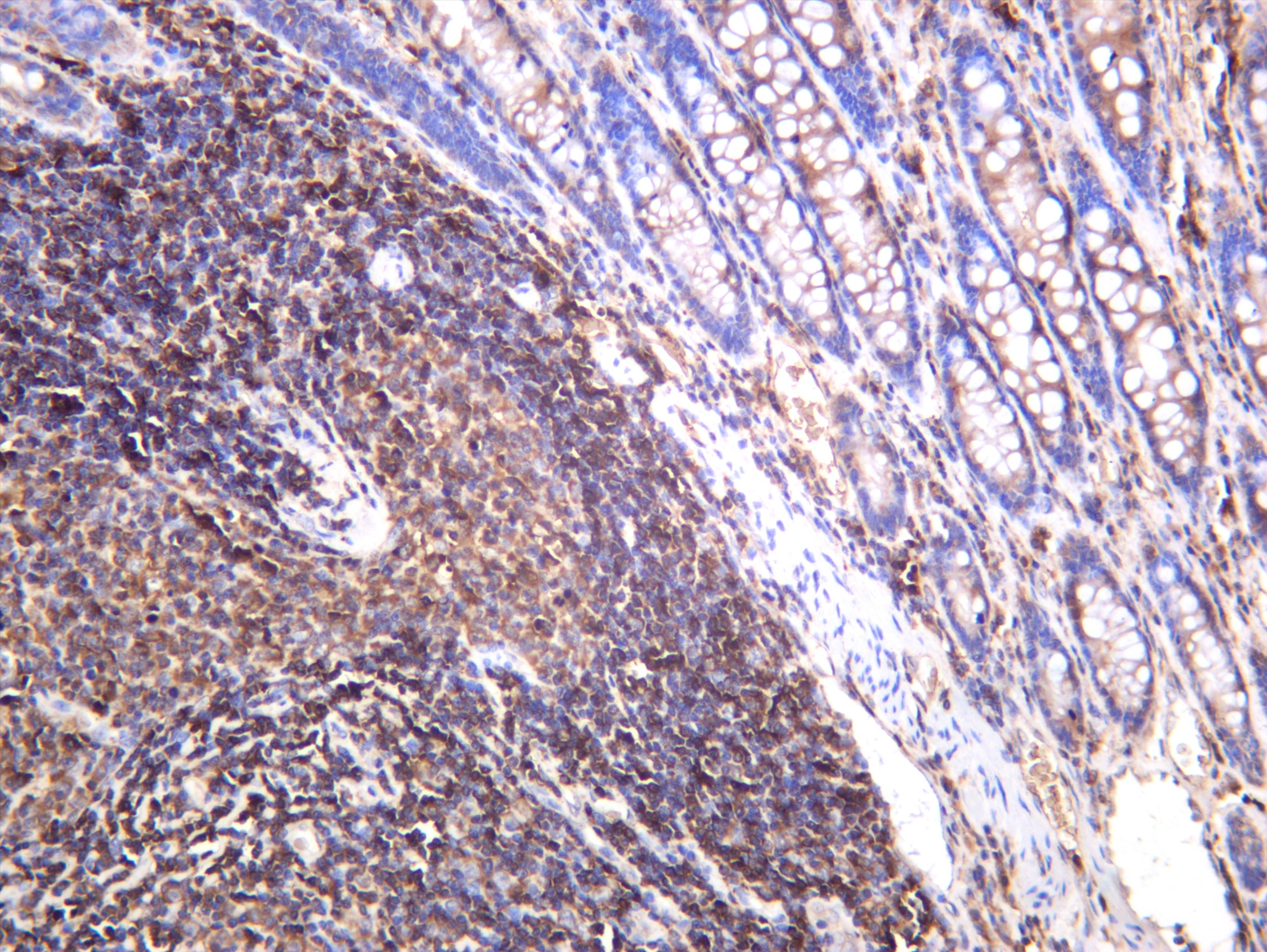 Human colon carcinoma was stained with anti-p90RSK (phospho Ser380) rabbit antibody