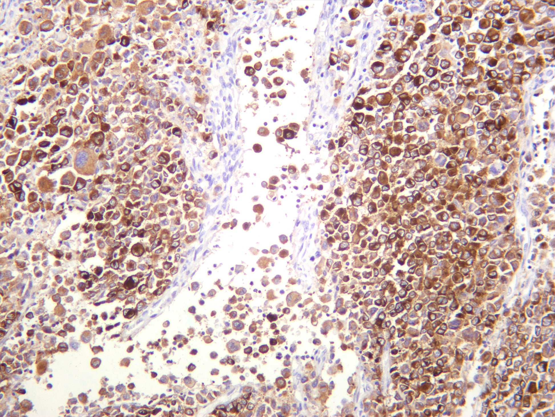 Human melanoma was stained with anti-MelanA (PT0408R) rabbit antibody