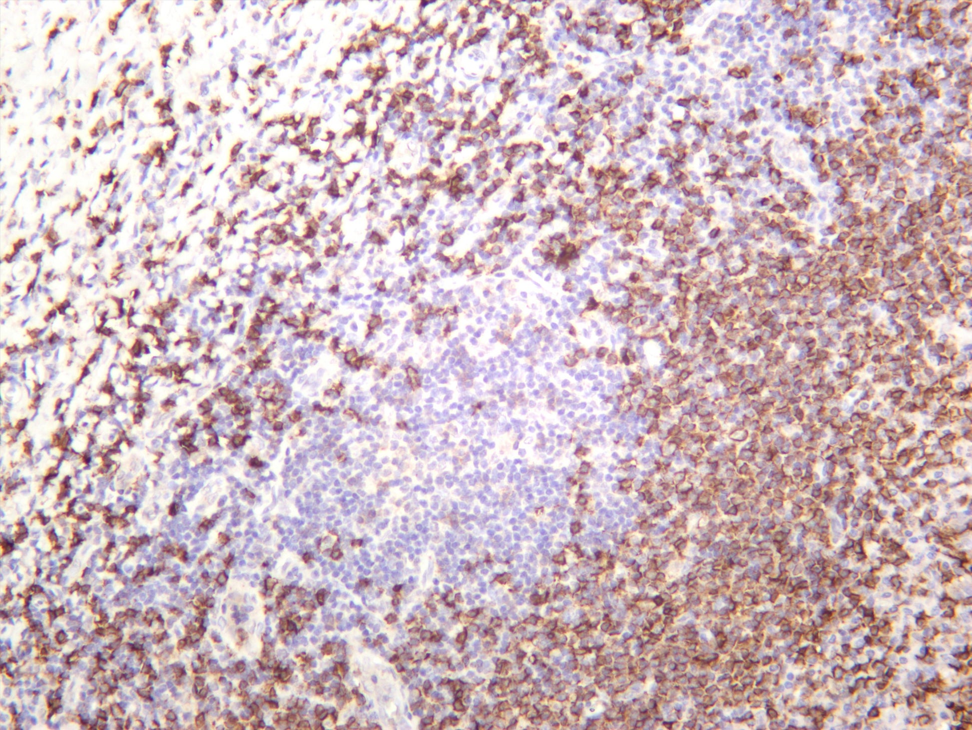Human tonsil was stained with anti-CD20 (PT0419R) rabbit antibody