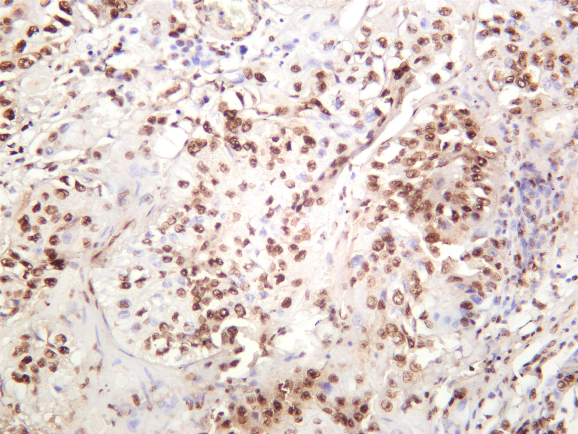 Human bladder carcinoma was stained with anti-DDX5 (PT0429R) rabbit antibody