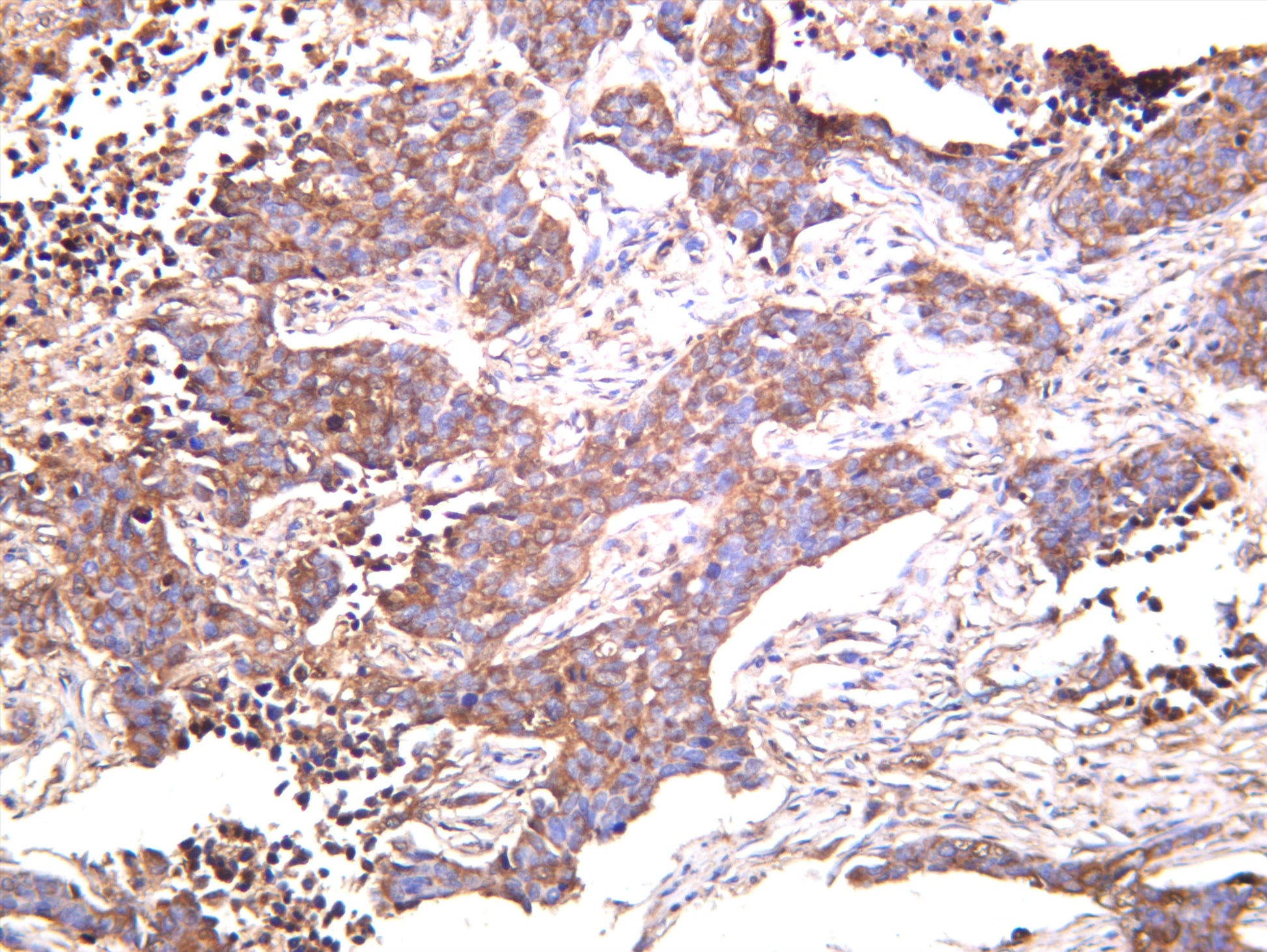 Human lung carcinoma was stained with anti-Sumo 1 (PT0513R) rabbit antibody