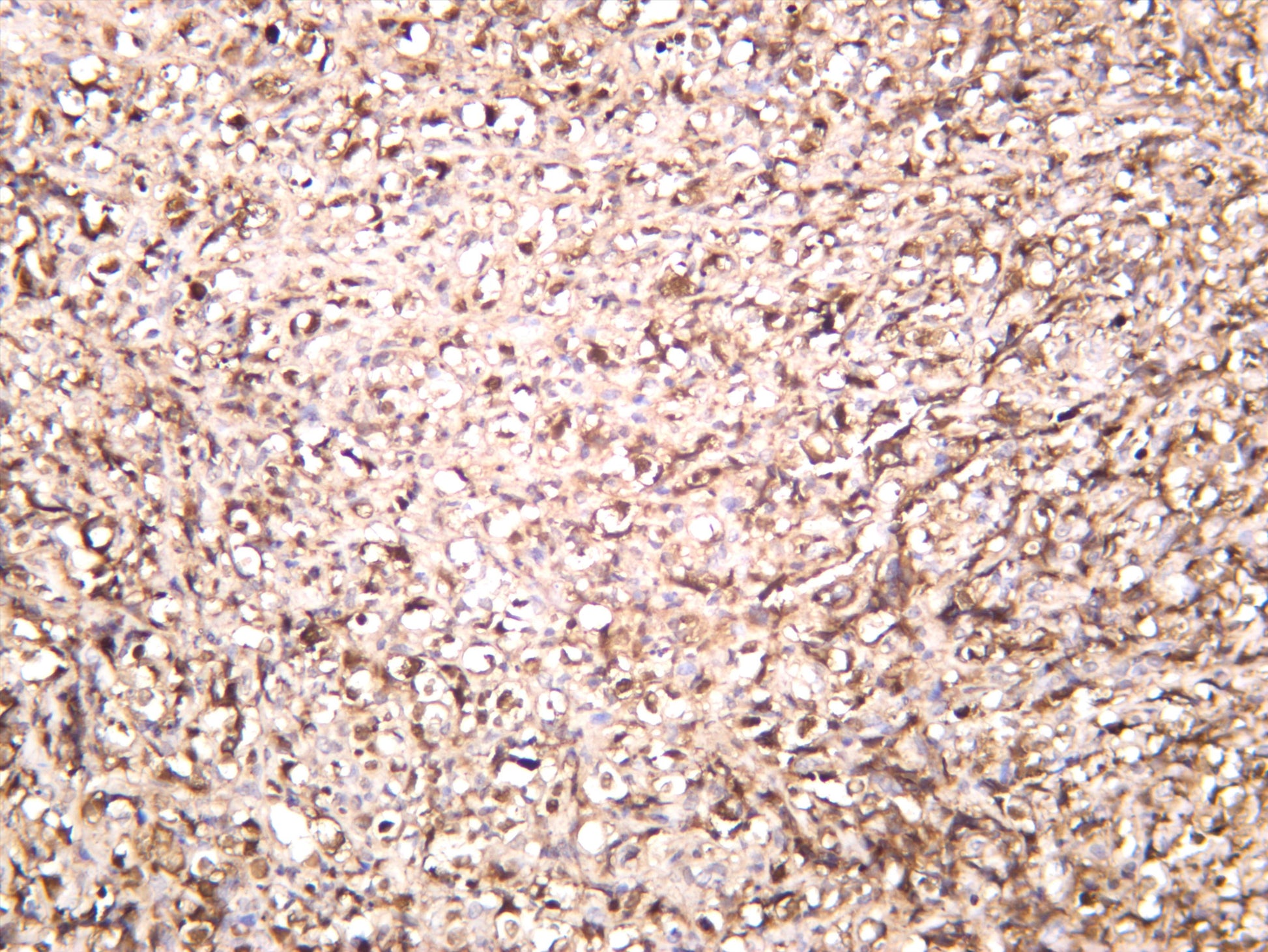 Human non-hodgkin lymphoma was stained with anti-ALK (PT0548R) rabbit antibody