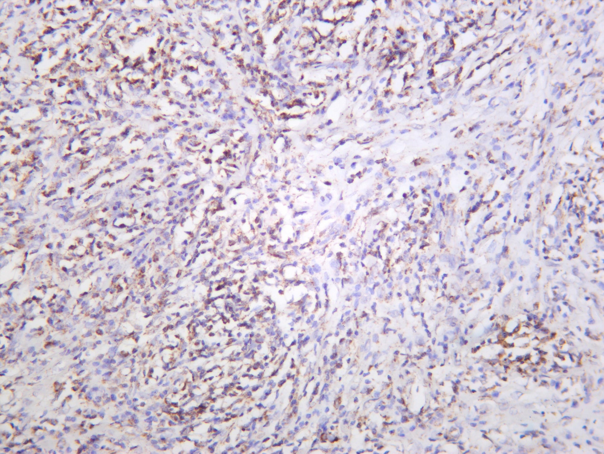 Human thyroid carcinoma was stained with anti-mtTFA (PT0565R) rabbit antibody