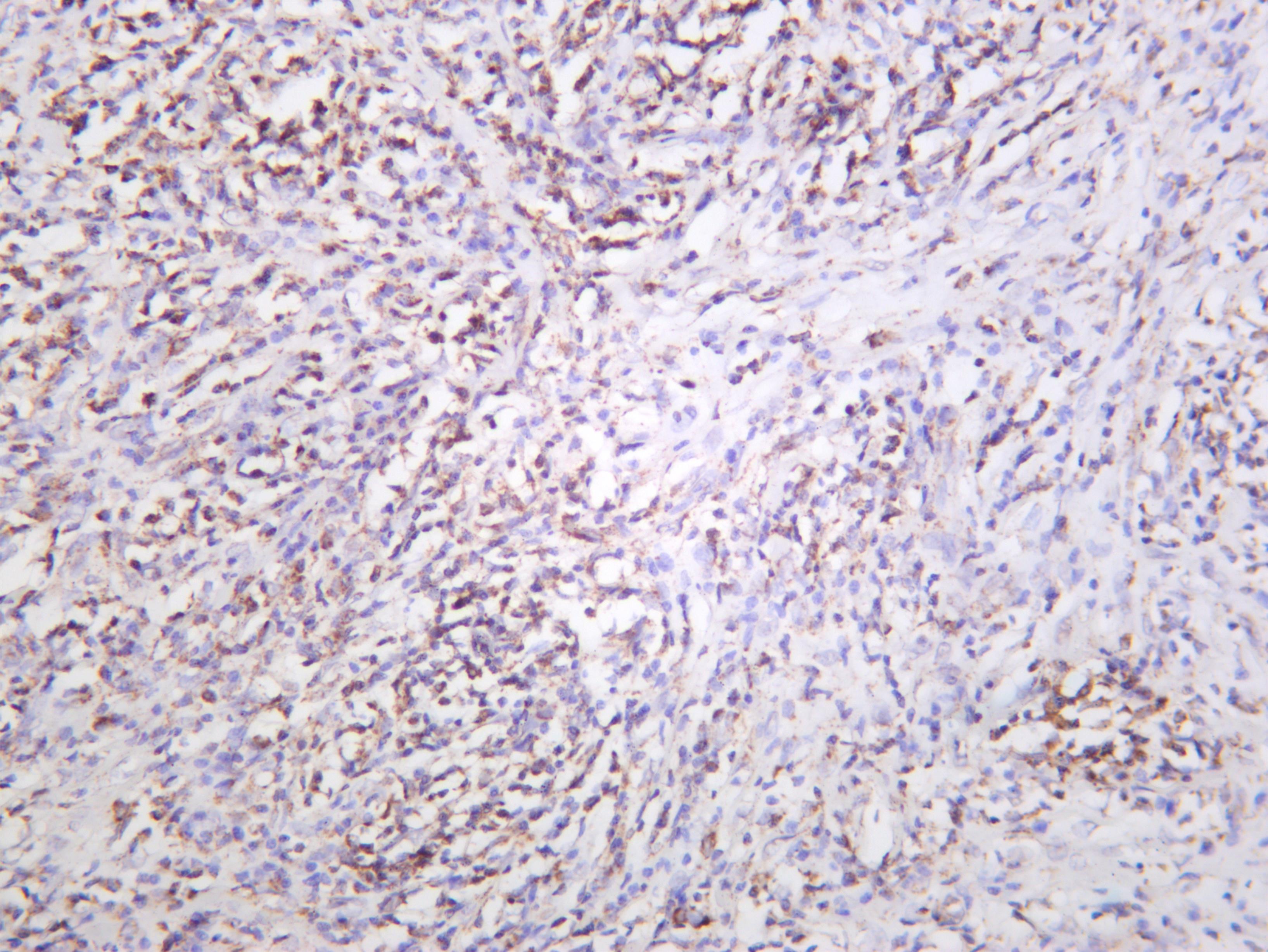 Human thyroid carcinoma was stained with anti-mtTFA (PT0565R) rabbit antibody