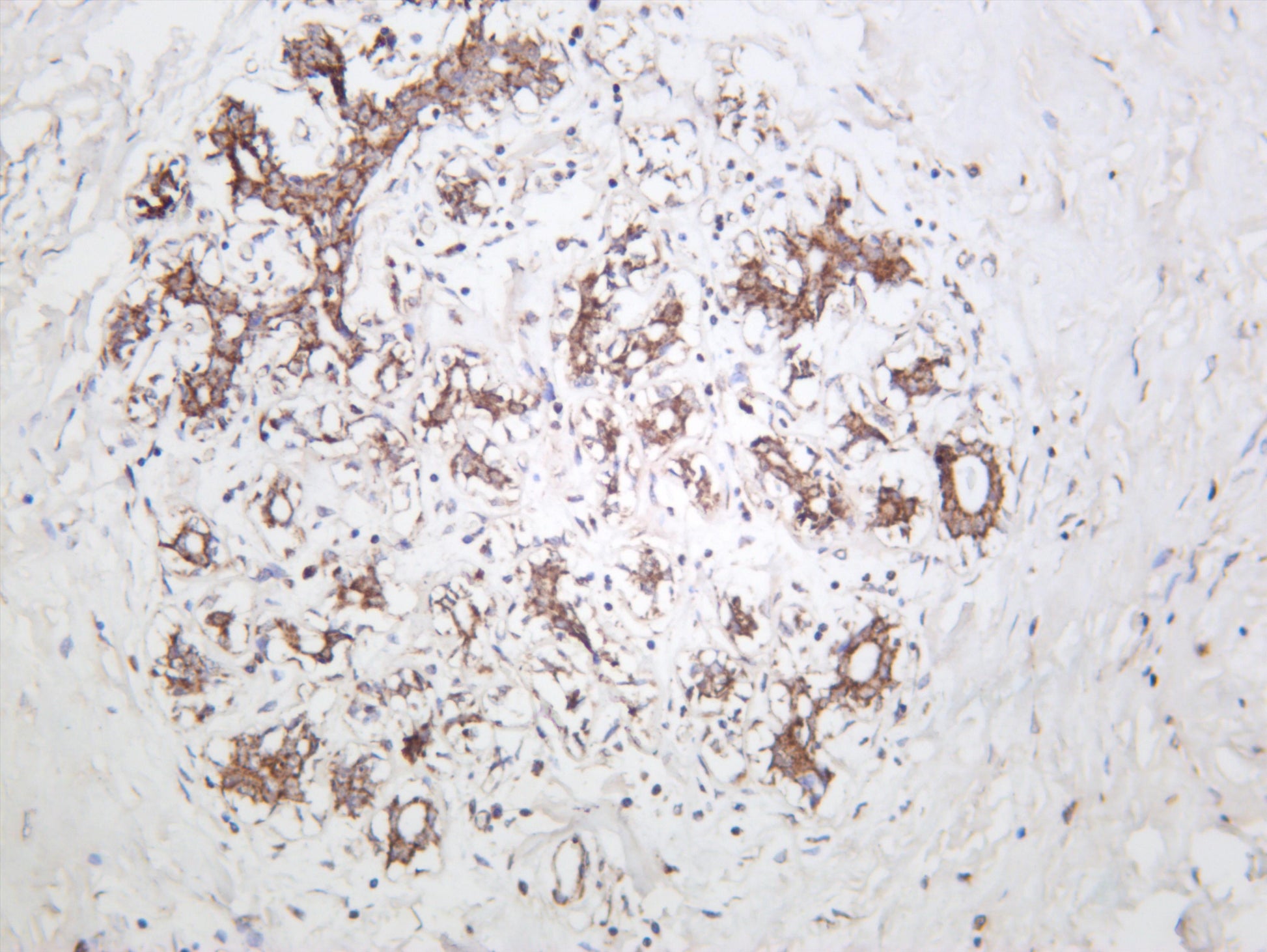 Human breast carcinoma was stained with anti-ACACB (PT0598R) rabbit antibody