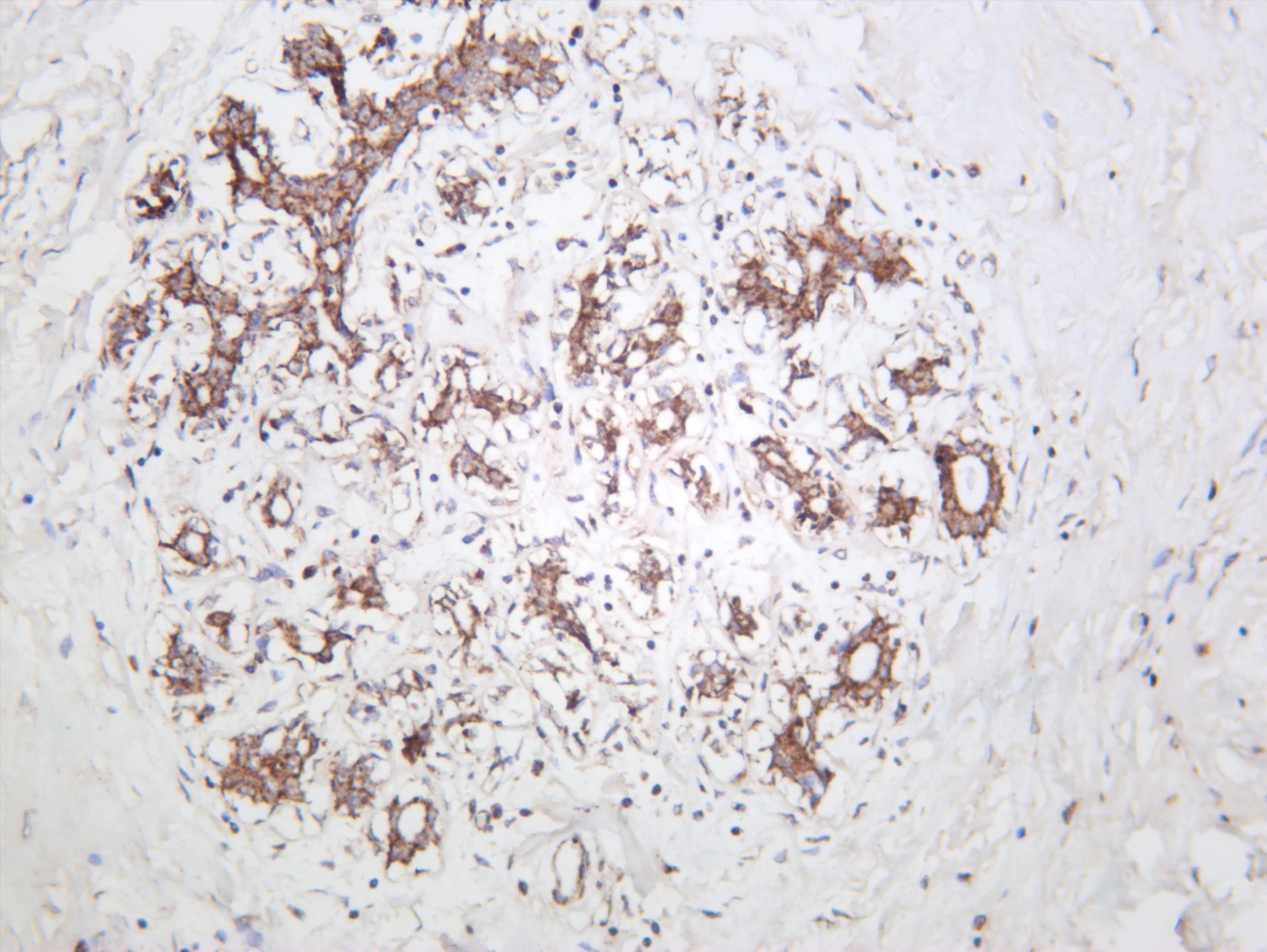 Human breast carcinoma was stained with anti-ACACB (PT0598R) rabbit antibody