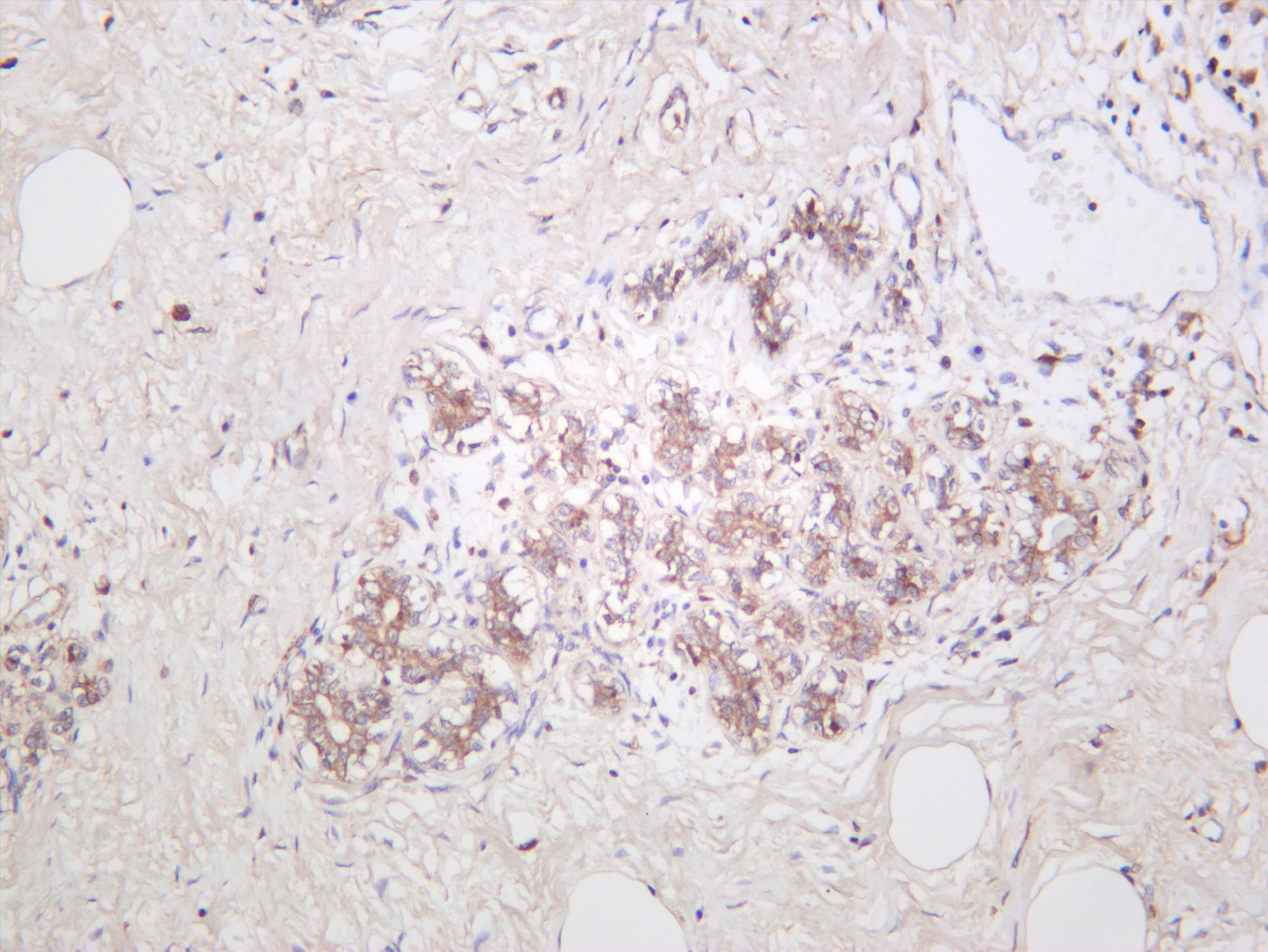 Human breast carcinoma was stained with anti-ASK1 (PT0599R) rabbit antibody
