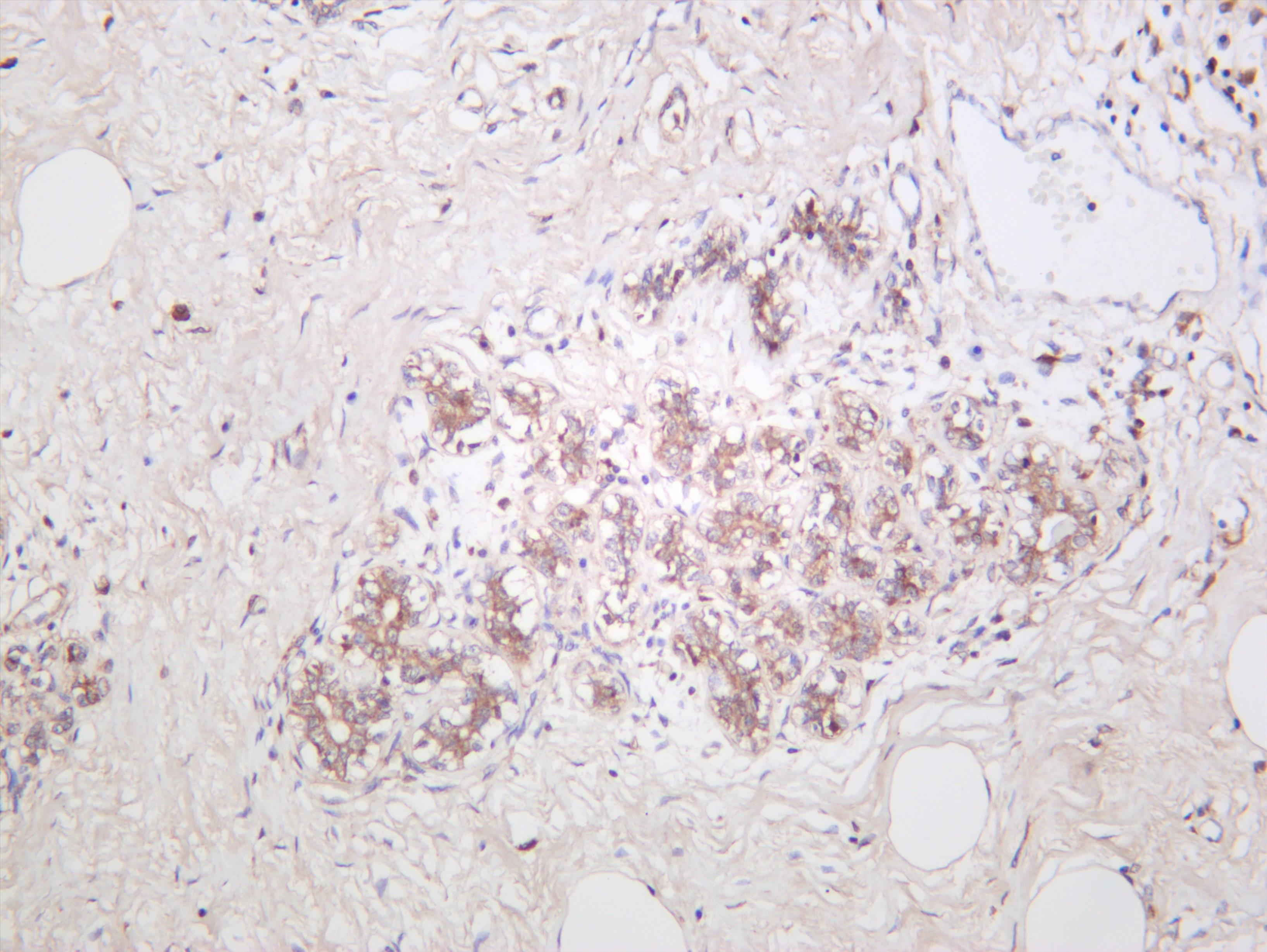 Human breast carcinoma was stained with anti-ASK1 (PT0599R) rabbit antibody