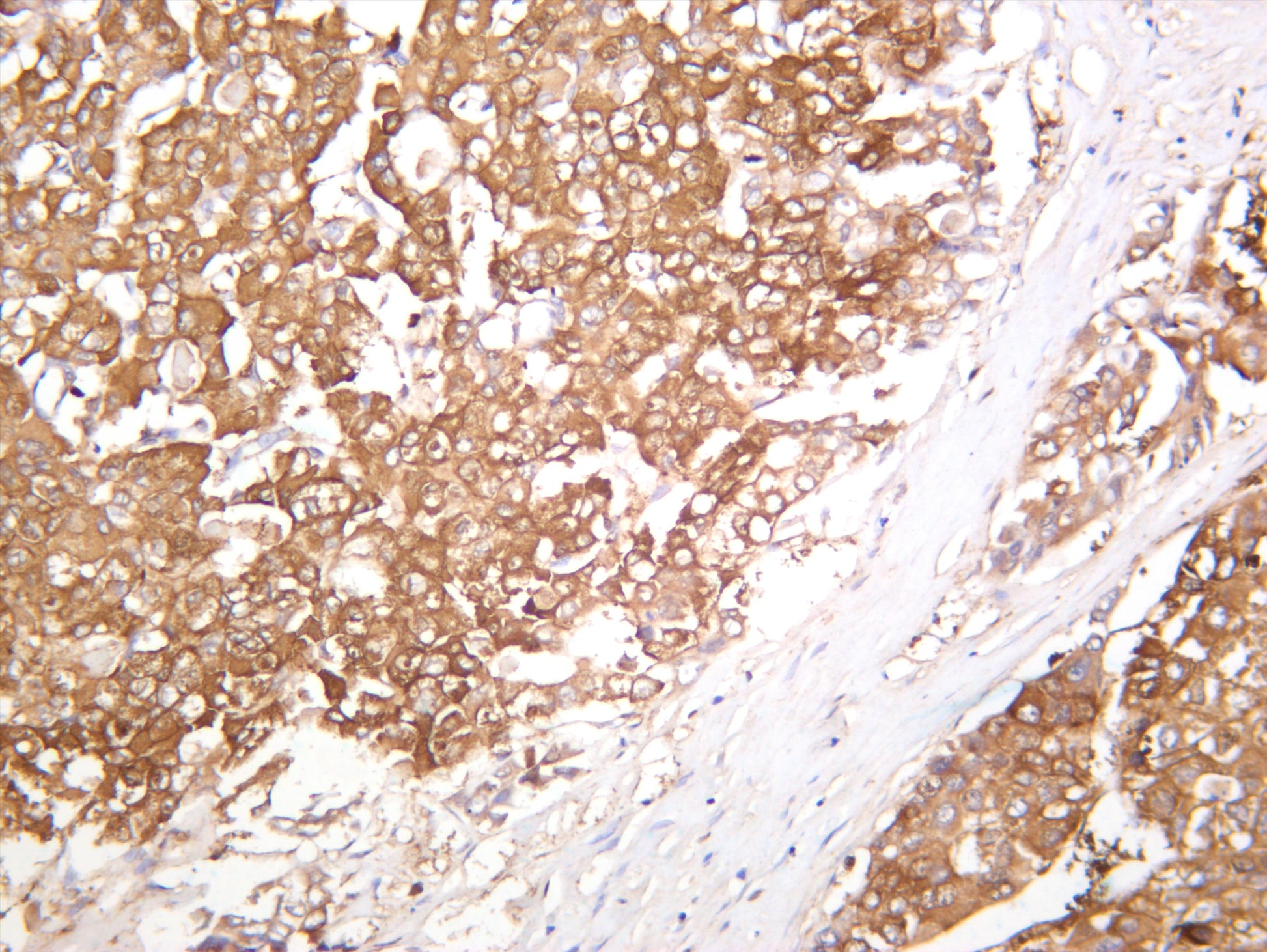 Human hepatocellular carcinoma was stained with anti-PUMA (PT0607R) rabbit antibody