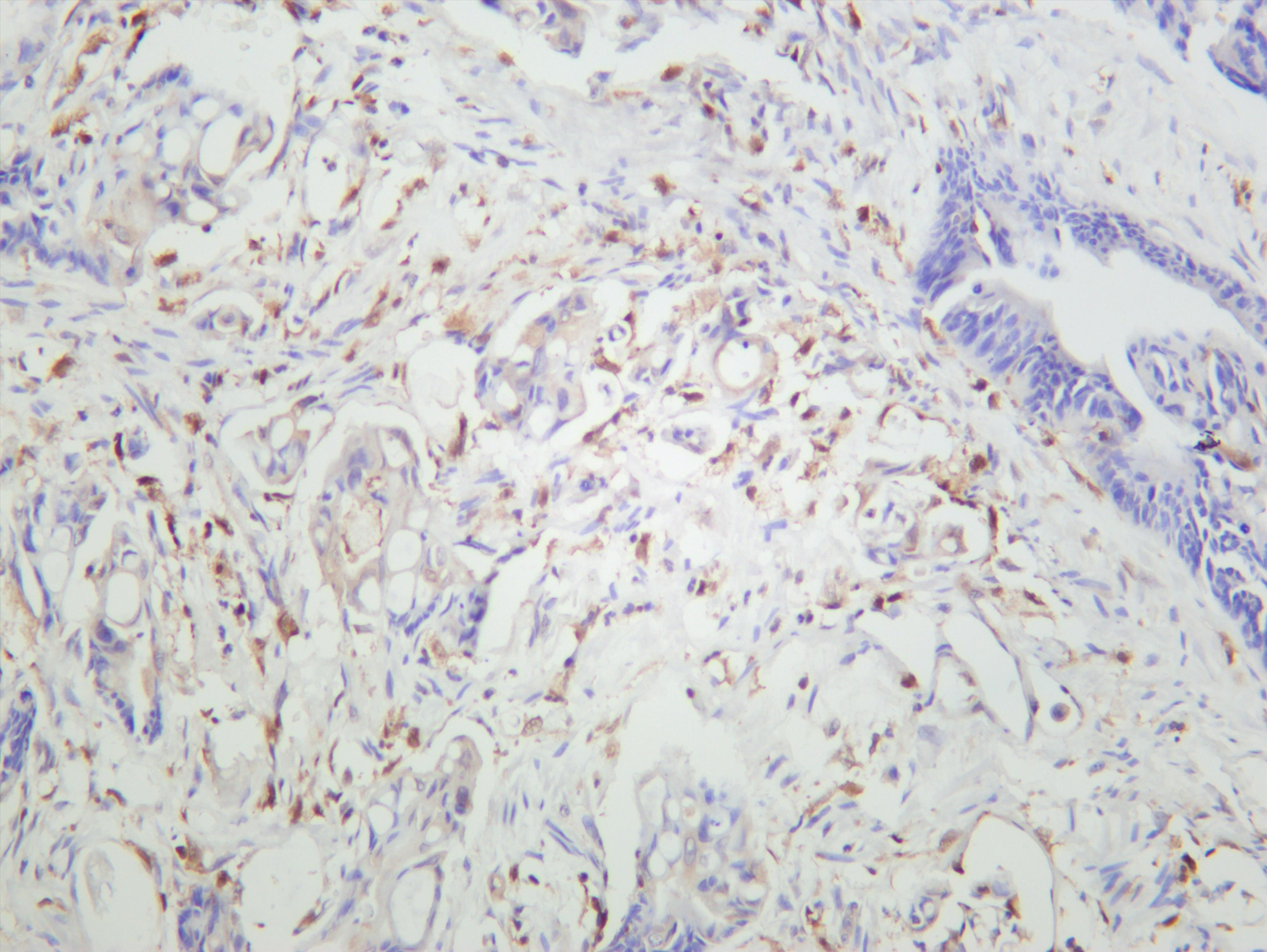 Human colon carcinoma was stained with anti-Caspase-1 (PT0628R) rabbit antibody