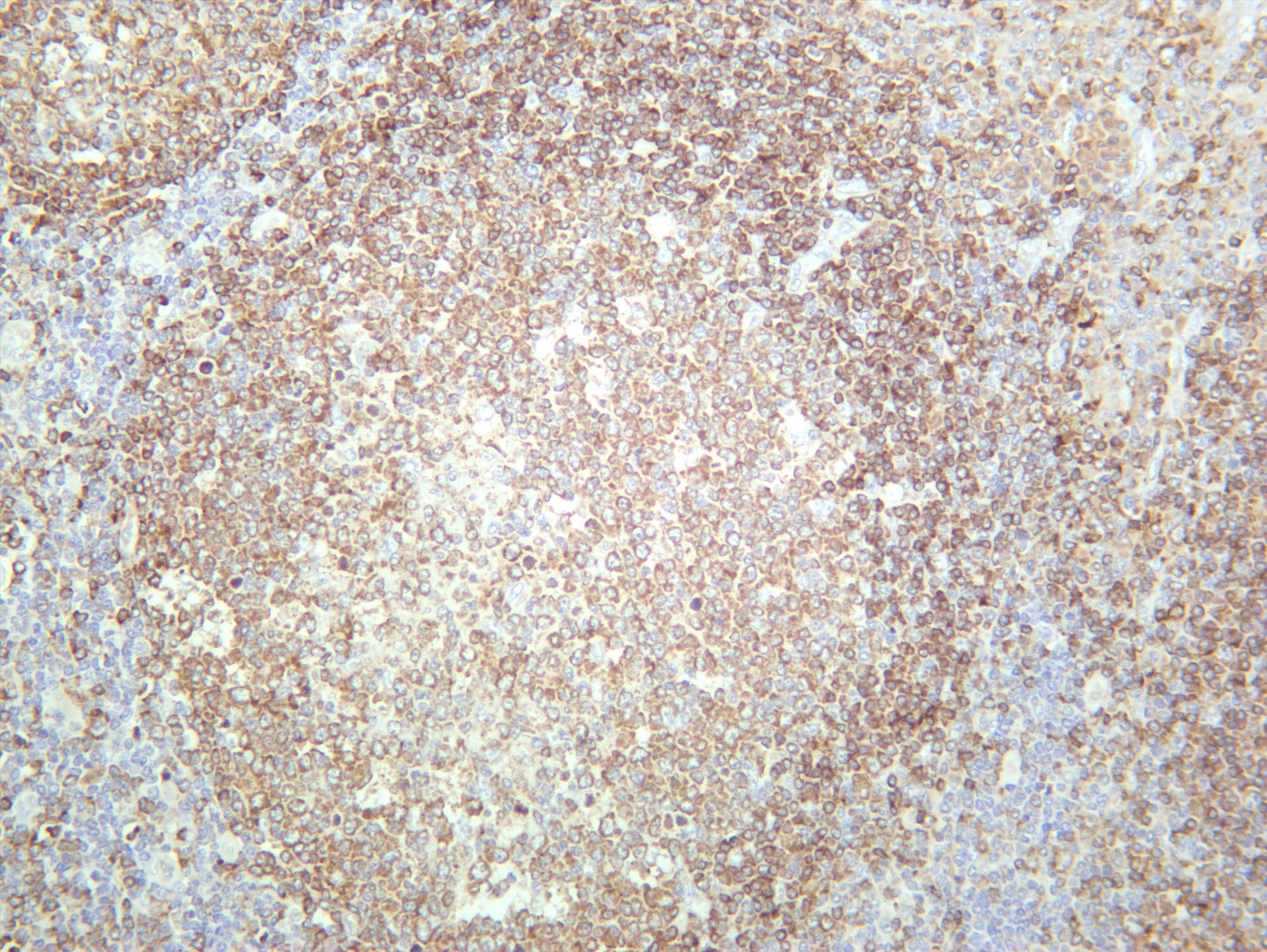 Human tonsil was stained with anti-BTK (PT0675R) rabbit antibody
