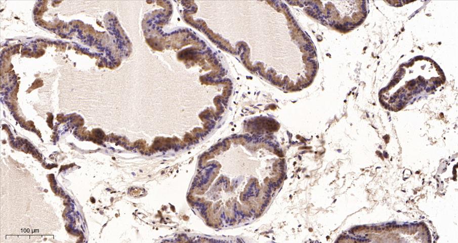 Immunohistochemical analysis of paraffin-embedded human Prostate tissue. 1,primary Antibody was diluted at 1:200(4Â°C,overnight). 2, EDTA pH 9.0 was used for antibody retrieval(>98Â°C,20min). 3,Secondary antibody was diluted at 1:200(room tempeRature, 30min).