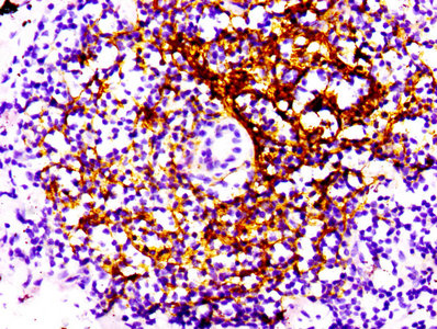 IHC image diluted at 1:100 and staining in paraffin-embedded human lung cancer performed on a Leica BondTM system. After dewaxing and hydration, antigen retrieval was mediated by high pressure in a citrate buffer (pH 6.0). Section was blocked with 10% normal goat serum 30min at RT. Then primary antibody (1% BSA) was incubated at 4? overnight. The primary is detected by a biotinylated secondary antibody and visualized using an HRP conjugated SP system.