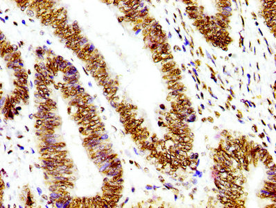 IHC image diluted at 1:100 and staining in paraffin-embedded human colon cancer performed on a Leica BondTM system. After dewaxing and hydration, antigen retrieval was mediated by high pressure in a citrate buffer (pH 6.0). Section was blocked with 10% normal goat serum 30min at RT. Then primary antibody (1% BSA) was incubated at 4? overnight. The primary is detected by a biotinylated secondary antibody and visualized using an HRP conjugated SP system.