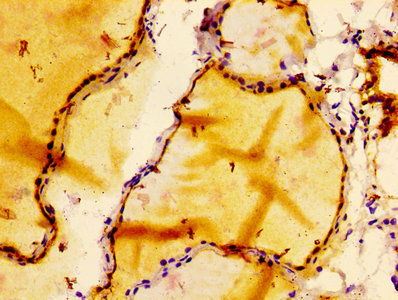 IHC image diluted at 1:100 and staining in paraffin-embedded human thyroid tissue performed on a Leica BondTM system. After dewaxing and hydration, antigen retrieval was mediated by high pressure in a citrate buffer (pH 6.0). Section was blocked with 10% normal goat serum 30min at RT. Then primary antibody (1% BSA) was incubated at 4Â°C overnight. The primary is detected by a biotinylated secondary antibody and visualized using an HRP conjugated SP system.