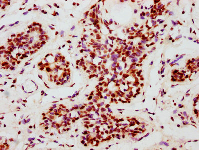 IHC image diluted at 1:100 and staining in paraffin-embedded human breast cancer performed on a Leica BondTM system. After dewaxing and hydration, antigen retrieval was mediated by high pressure in a citrate buffer (pH 6.0). Section was blocked with 10% normal goat serum 30min at RT. Then primary antibody (1% BSA) was incubated at 4? overnight. The primary is detected by a biotinylated secondary antibody and visualized using an HRP conjugated SP system.