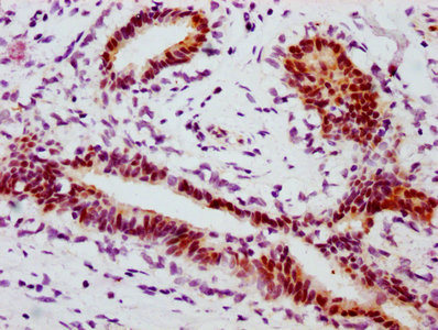 IHC image diluted at 1:100 and staining in paraffin-embedded human breast cancer performed on a Leica BondTM system. After dewaxing and hydration, antigen retrieval was mediated by high pressure in a citrate buffer (pH 6.0). Section was blocked with 10% normal goat serum 30min at RT. Then primary antibody (1% BSA) was incubated at 4? overnight. The primary is detected by a biotinylated secondary antibody and visualized using an HRP conjugated SP system.